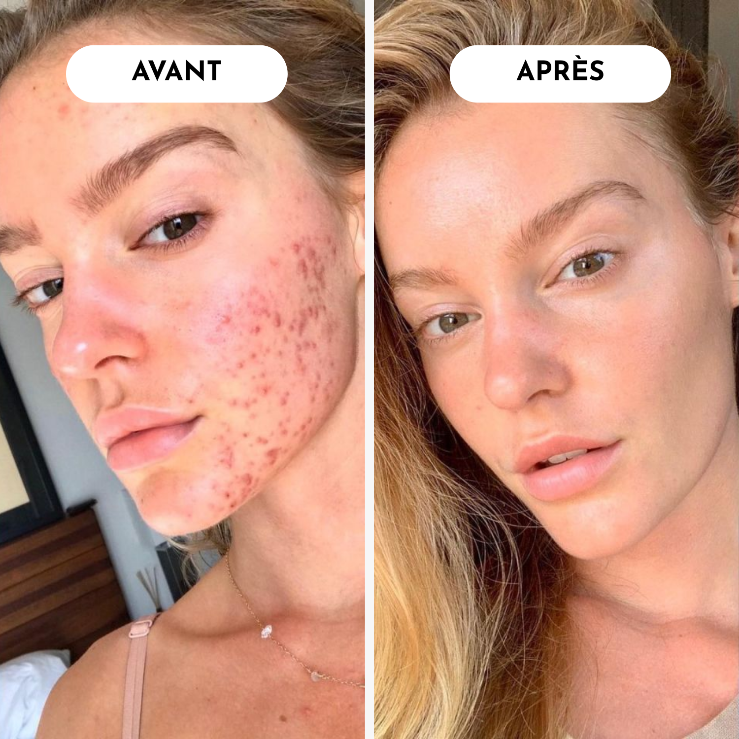 STOP Acné & Boutons : Votre Peau Nette en 10 Jours Garanti