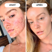 STOP Acné & Boutons : Votre Peau Nette en 10 Jours Garanti